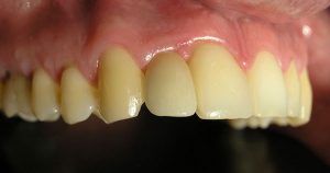 Zubni implant