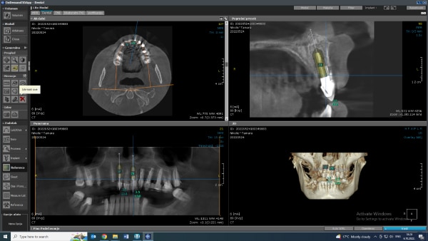 Digitalni snimak vilice i zubni implant
