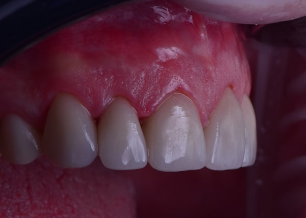 Fasete za zube u estetskoj stomatologiji