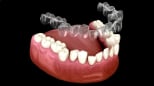 Folije za zube i ortodoncija