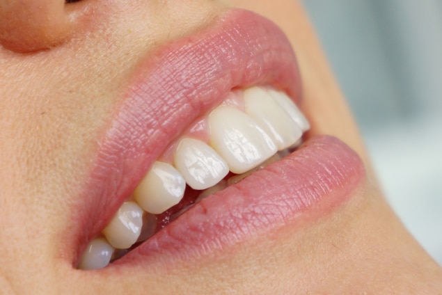 Izbeljivanje zuba estetska stomatologija