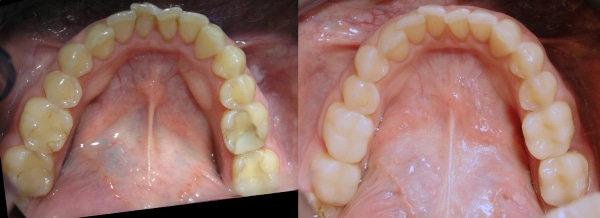 Pre i posle lecenja i popravke zuba