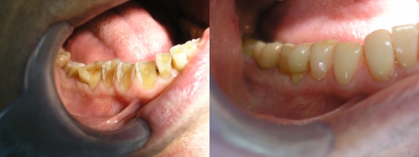 Pre i posle popravke zuba
