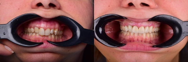 Pre i posle tretmana estetske stomatologije