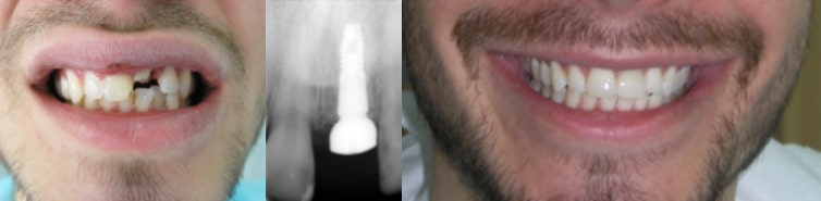 Pre i posle ugradnje zubnog implantata