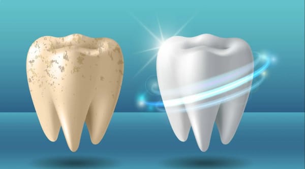 Zub pre i posle izbeljivanja