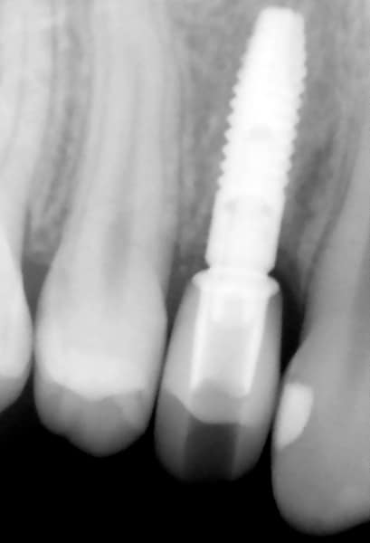 Zubni implant